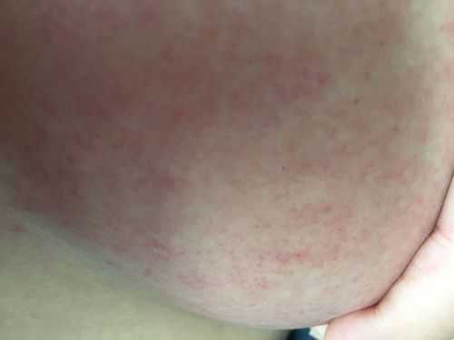 孕期胸部痒(孕期胸部痒是怎么回事) 第3张 孕期胸部痒(孕期胸部痒是怎么回事) 第3张