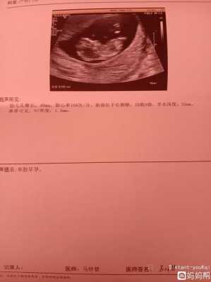 孕期检查nt（孕期检查nt检查什么的）  第3张