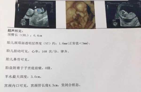 孕期nt检查(孕期nt检查什么项目) 第1张 孕期nt检查(孕期nt检查什么项目) 第1张