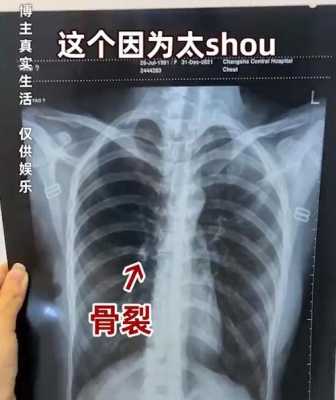胎儿少一根肋骨能要吗(胎儿少一根肋骨长大后会有影响吗) 第2张 胎儿少一根肋骨能要吗(胎儿少一根肋骨长大后会有影响吗) 第2张