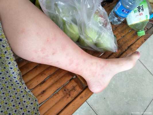 孕期腿痒(孕期腿痒怎么回事) 第1张 孕期腿痒(孕期腿痒怎么回事) 第1张