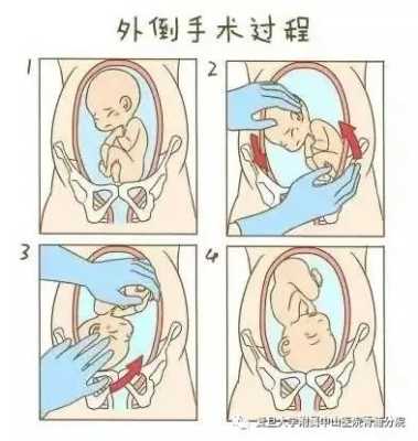 怎么让胎儿转身(怎么让胎儿转身) 第1张 怎么让胎儿转身(怎么让胎儿转身) 第1张