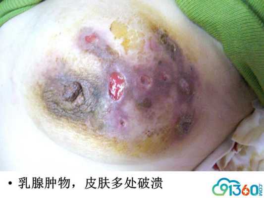 孕期乳腺炎(孕期乳腺炎) 第2张 孕期乳腺炎(孕期乳腺炎) 第2张