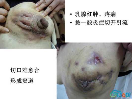 孕期乳腺炎(孕期乳腺炎) 第1张 孕期乳腺炎(孕期乳腺炎) 第1张