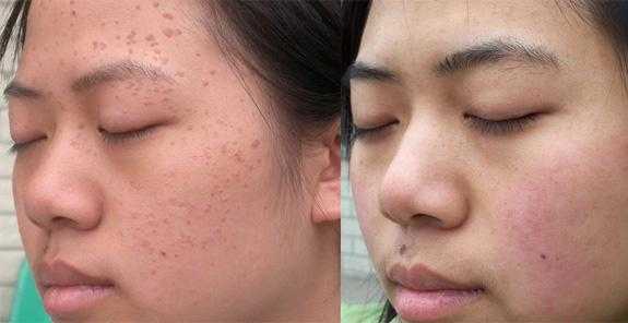 孕期扁平疣（我于怀孕期间在脸，胸部长了一些丝状疣和扁平疣，怎么办）  第1张