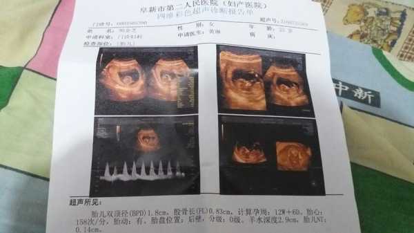 怀孕十二周胎儿多大(孕十二周胎心162,这个数据正常吗) 第2张 怀孕十二周胎儿多大(孕十二周胎心162,这个数据正常吗) 第2张