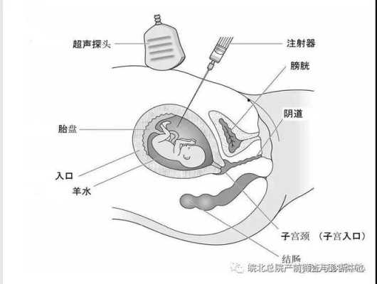 孕期穿刺（羊膜穿刺是检查什么）  第1张