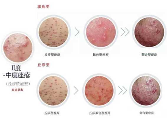 孕期长痘痘怎么办(孕期长痘痘怎么办最快消除) 第3张 孕期长痘痘怎么办(孕期长痘痘怎么办最快消除) 第3张