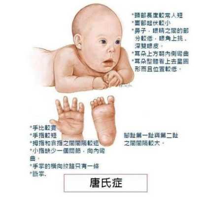 什么叫唐氏综合症,孕期综合症有哪些症状 第2张 什么叫唐氏综合症,孕期综合症有哪些症状 第2张
