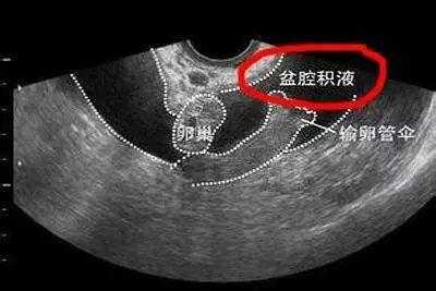 孕期盆腔积液(孕期盆腔积液) 第2张 孕期盆腔积液(孕期盆腔积液) 第2张