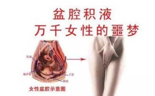 孕期盆腔积液(孕期盆腔积液) 第1张 孕期盆腔积液(孕期盆腔积液) 第1张