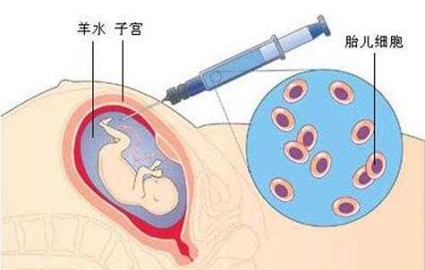羊水穿刺会影响胎儿吗(孕妇抽羊水检查对胎儿有危害吗) 第2张 羊水穿刺会影响胎儿吗(孕妇抽羊水检查对胎儿有危害吗) 第2张