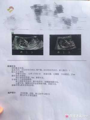 孕12周胎心率180正常吗,孕十二周胎儿真实图片欣赏 第2张 孕12周胎心率180正常吗,孕十二周胎儿真实图片欣赏 第2张