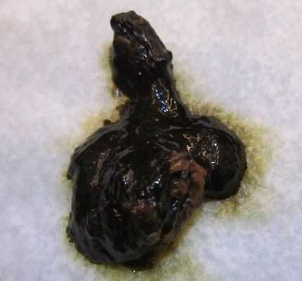 孕妇大便吃益中是黑色的怎么回事,孕期大便黑色是什么原因  第2张