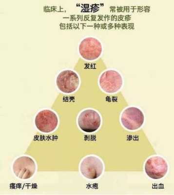 皮肤过敏会影响胎儿吗(皮肤过敏会影响胎儿吗知乎) 第2张 皮肤过敏会影响胎儿吗(皮肤过敏会影响胎儿吗知乎) 第2张