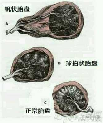 帆状胎盘的胎儿能要吗(帆状胎盘对胎儿有影响吗) 第3张 帆状胎盘的胎儿能要吗(帆状胎盘对胎儿有影响吗) 第3张