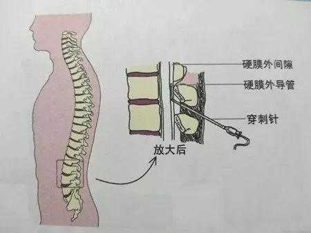 全麻衬与半麻衬的区别,半麻对胎儿的影响 第2张 全麻衬与半麻衬的区别,半麻对胎儿的影响 第2张