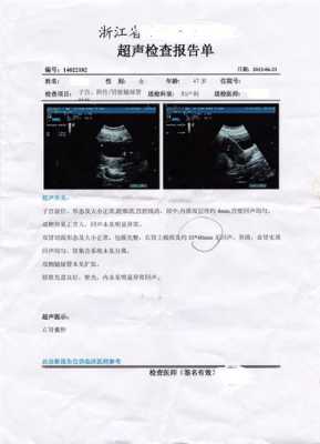 胎儿右肾有囊肿怎么办(右肾囊肿是怎么一回事呢) 第2张 胎儿右肾有囊肿怎么办(右肾囊肿是怎么一回事呢) 第2张
