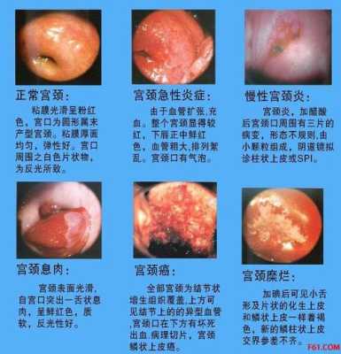 孕期宫颈息肉怎么办,孕期宫颈炎会影响胎儿发育吗  第1张