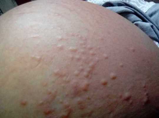 怀孕后皮肤发痒是怎么回事,怀孕期间过敏了怎么办啊 第2张 怀孕后皮肤发痒是怎么回事,怀孕期间过敏了怎么办啊 第2张