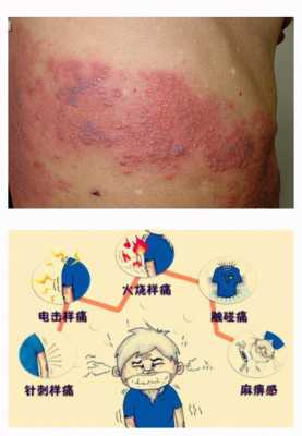 孕期带状疱疹如何治疗,孕期带状疱疹对胎儿的影响 第1张 孕期带状疱疹如何治疗,孕期带状疱疹对胎儿的影响 第1张