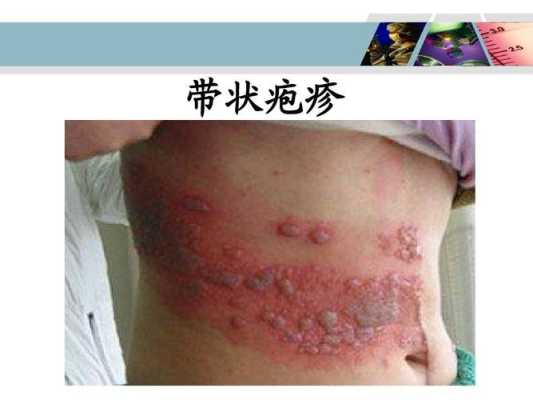 孕期带状疱疹如何治疗,孕期带状疱疹对胎儿的影响 第2张 孕期带状疱疹如何治疗,孕期带状疱疹对胎儿的影响 第2张
