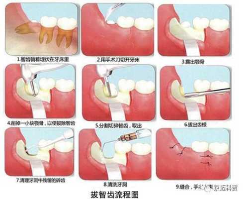 孕期拔智齿(孕6周+,智齿发炎疼,孕期可以拔牙吗) 第1张 孕期拔智齿(孕6周+,智齿发炎疼,孕期可以拔牙吗) 第1张