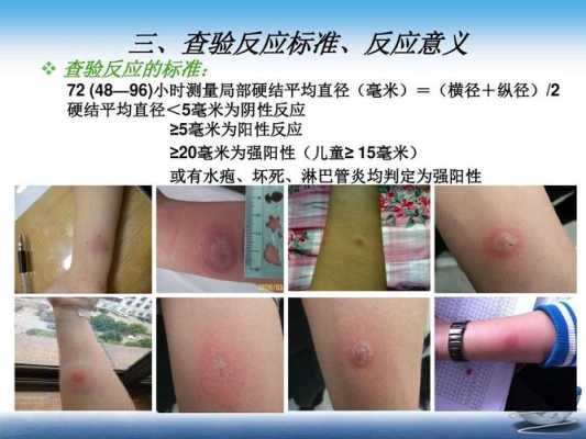 怀孕期间能做吗（结核菌素试验怀孕期间能做吗）  第1张