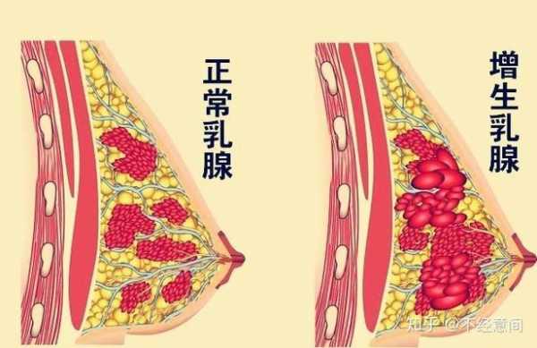 孕期乳腺增生（乳腺增生样改变是什么意思）  第2张