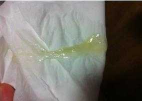 怀孕期间白带发黄对宝宝有影响吗,孕妇尿完尿一擦黄绿色分泌物 第2张 怀孕期间白带发黄对宝宝有影响吗,孕妇尿完尿一擦黄绿色分泌物 第2张