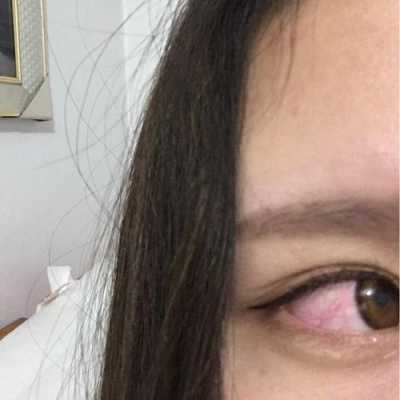 孕期眼睛疼(孕妇眼睛发炎怎么办) 第1张 孕期眼睛疼(孕妇眼睛发炎怎么办) 第1张
