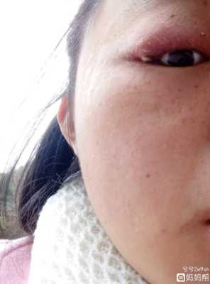 孕期眼睛疼(孕妇眼睛发炎怎么办) 第2张 孕期眼睛疼(孕妇眼睛发炎怎么办) 第2张