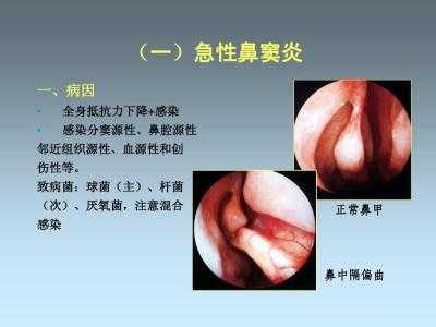 鼻窦炎对胎儿有影响吗(鼻窦炎对胎儿有影响吗) 第2张 鼻窦炎对胎儿有影响吗(鼻窦炎对胎儿有影响吗) 第2张