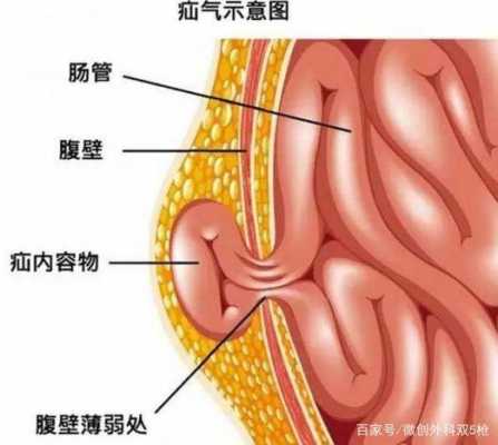 孕期疝气(孕期疝气需要注意什么) 第2张 孕期疝气(孕期疝气需要注意什么) 第2张