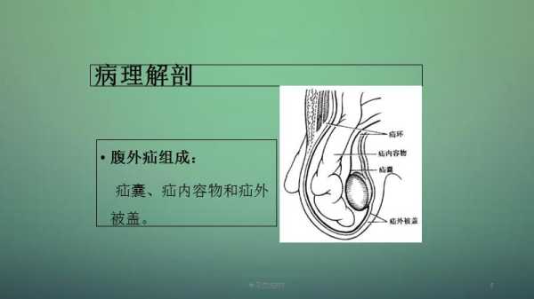 孕期疝气(孕期疝气需要注意什么) 第3张 孕期疝气(孕期疝气需要注意什么) 第3张