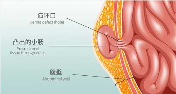 孕期疝气(孕期疝气需要注意什么) 第1张 孕期疝气(孕期疝气需要注意什么) 第1张
