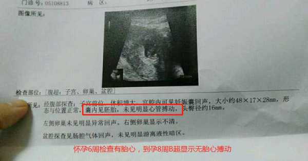 造成胎儿没有胎心的原因有哪些(造成胎儿没有胎心的原因有哪些呢) 第2张 造成胎儿没有胎心的原因有哪些(造成胎儿没有胎心的原因有哪些呢) 第2张