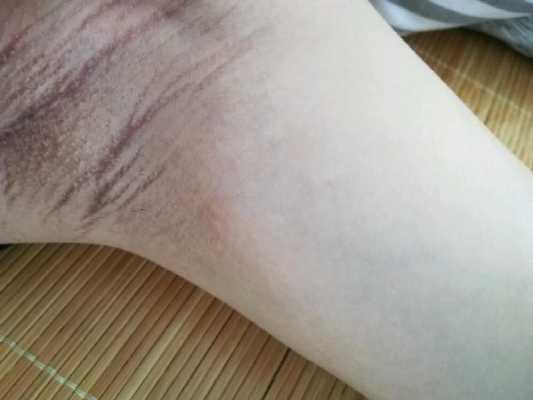 孕期腋下变黑(孕期腋下变黑) 第2张 孕期腋下变黑(孕期腋下变黑) 第2张