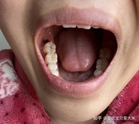 孕期长智齿(孕期长智齿了怎么办) 第2张 孕期长智齿(孕期长智齿了怎么办) 第2张