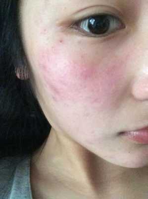 孕妇脸痒是怎么回事,孕期脸过敏了红肿痒怎么缓解  第2张