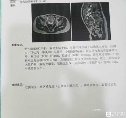 胎儿侧脑室增宽是什么原因导致的(胎儿侧脑室增宽是什么原因导致的怎么治疗) 第1张 胎儿侧脑室增宽是什么原因导致的(胎儿侧脑室增宽是什么原因导致的怎么治疗) 第1张