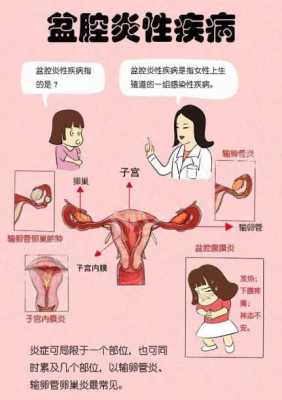 孕期盆腔炎（孕期盆腔炎有什么症状呢）  第1张
