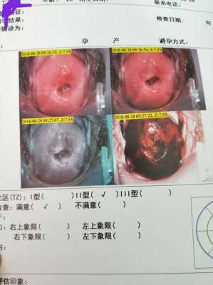 孕早期宫颈息肉流血怎么办,孕期宫颈息肉出血怎么止血 第2张 孕早期宫颈息肉流血怎么办,孕期宫颈息肉出血怎么止血 第2张