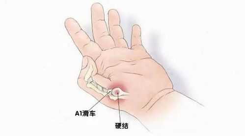 孕期腱鞘炎怎么办,孕期腱鞘炎怎么治疗最好最有效  第2张