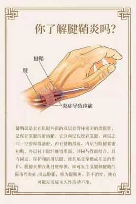 孕期腱鞘炎怎么办,孕期腱鞘炎怎么治疗最好最有效  第1张