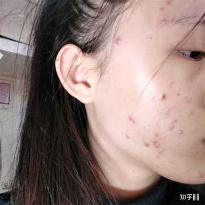 孕期下巴长痘(孕期下巴长痘痘是什么原因造成的) 第2张 孕期下巴长痘(孕期下巴长痘痘是什么原因造成的) 第2张