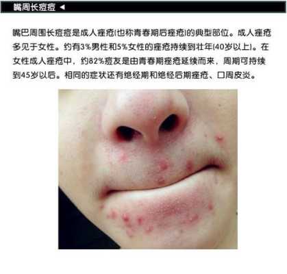 孕期下巴长痘(孕期下巴长痘痘是什么原因造成的) 第1张 孕期下巴长痘(孕期下巴长痘痘是什么原因造成的) 第1张