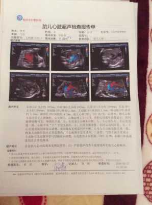 胎儿超声(胎儿心脏超声检查是什么) 第1张 胎儿超声(胎儿心脏超声检查是什么) 第1张