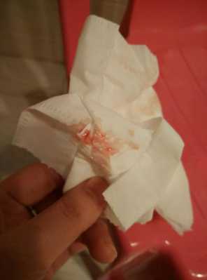 怀孕初期有轻微出血怎么回事,早孕期间出血是怎么回事 第2张 怀孕初期有轻微出血怎么回事,早孕期间出血是怎么回事 第2张