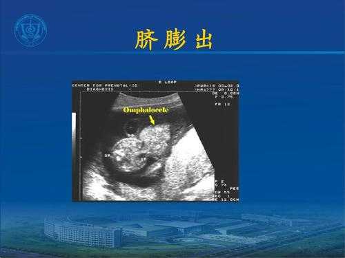 胎儿脐(胎儿脐膨出是什么原因导致的呢) 第2张 胎儿脐(胎儿脐膨出是什么原因导致的呢) 第2张